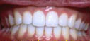 invisalign bangkok, dental bangkok, dental clinic bangkok, dental bridges, dental crown, dental treatment, dental veneers, dentist bangkok